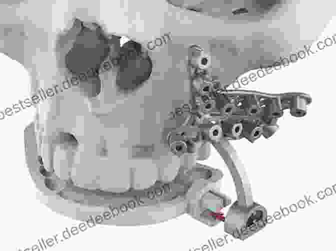 3D Printed Surgical Plan For Orthognathic Surgery 3D Printing In Oral Maxillofacial Surgery