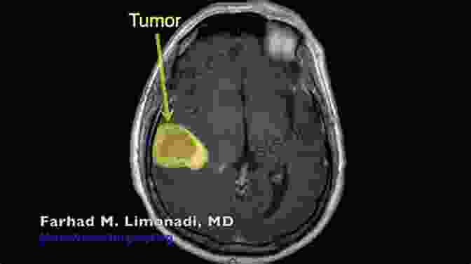 Photomicrograph Of A Brain Biopsy Showing A Glioblastoma Microneurosurgery Volume IVA: CNS Tumors: Surgical Anatomy Neuropathology Neuroradiology Neurophysiology Clinical Considerations Operability Treatment Options