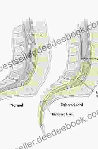 Tethered Cord Syndrome In Children And Adults